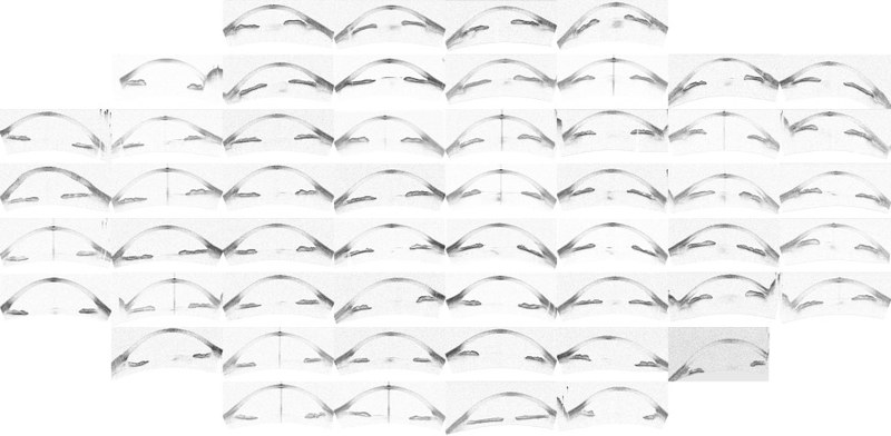 Image processing method for glaucoma detection and computer program. MKT2019/0167_H