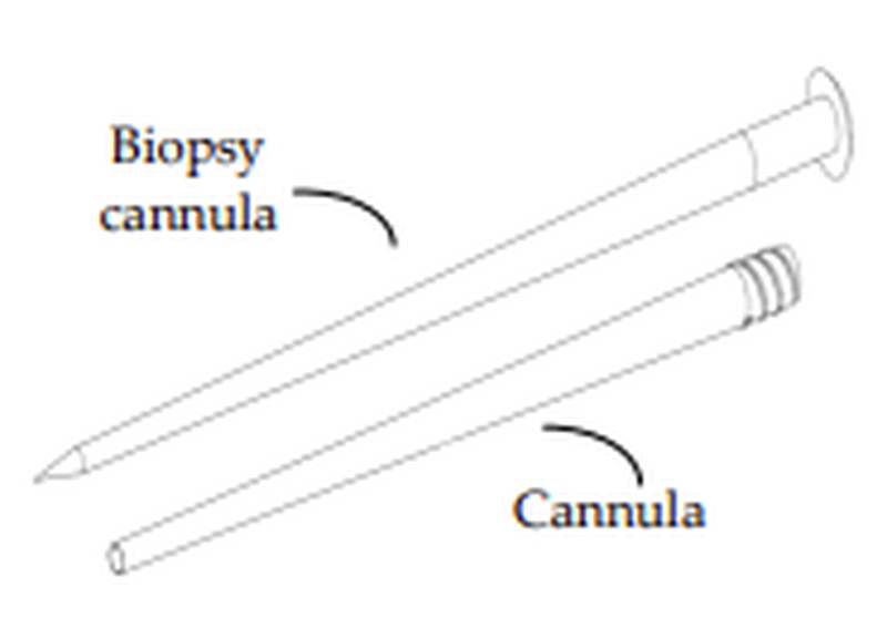 Novel conic cannula for spine cement injection. MKT2014/0152_H