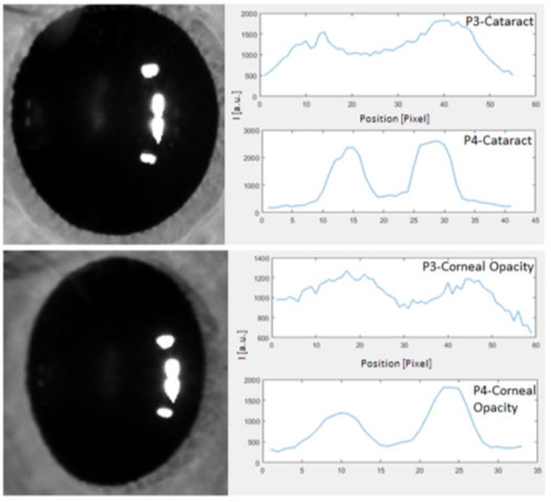 Non–invasive method for the objective assessment of the intraocular scattering of the cornea and the crystaline lens. MKT2019/0165_H
